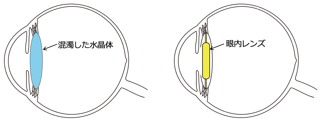 炎症性緑内障はどのように診断されますか?